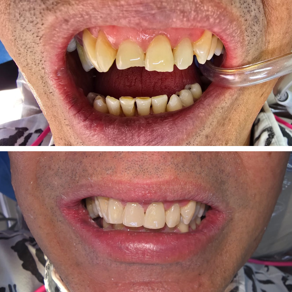 Caso 1 - Antes/Después