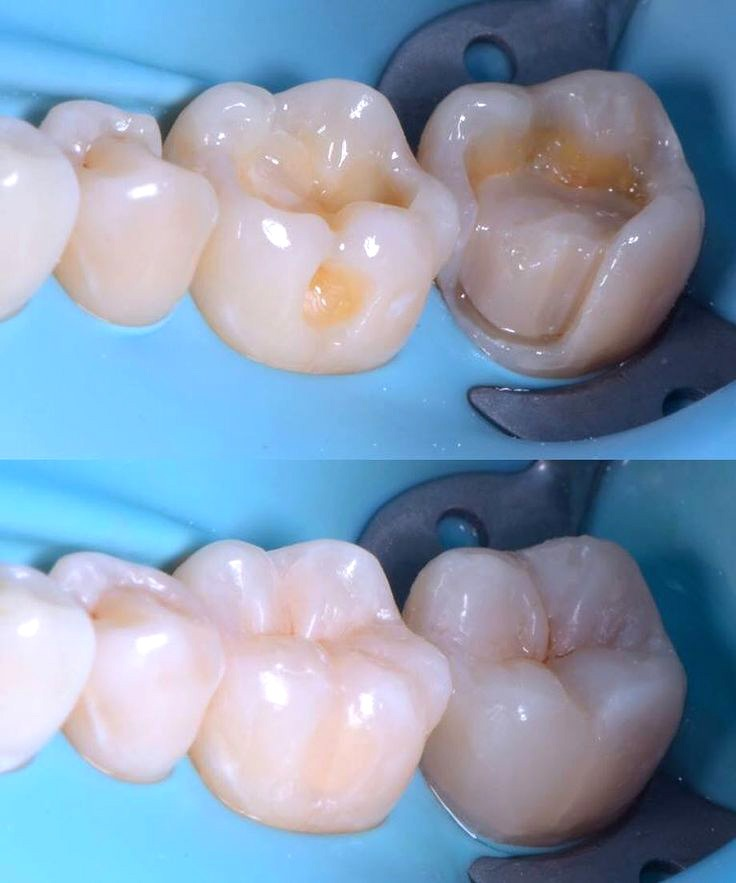 Calzas Estéticas - Restauración completa