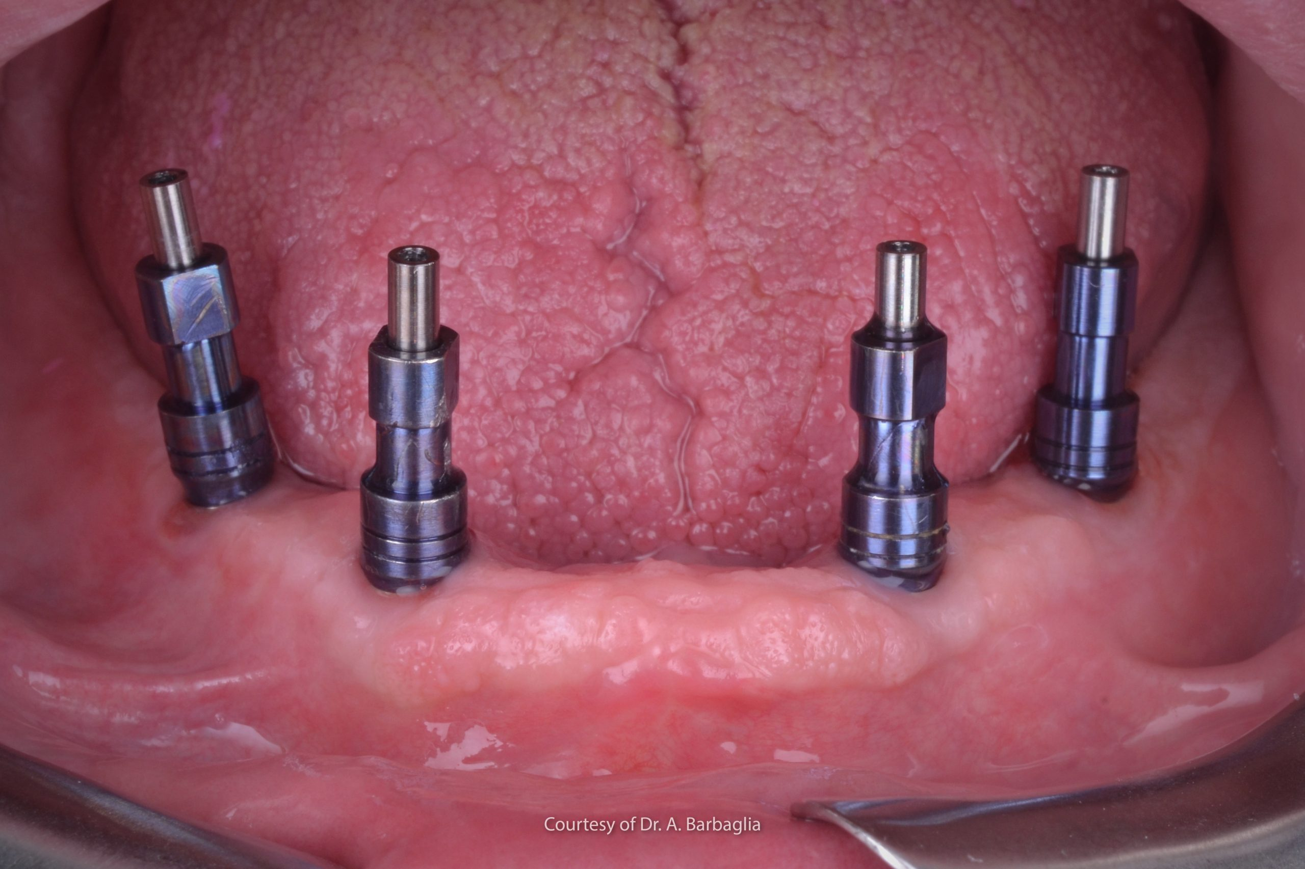 Implante Múltiple - Rehabilitación oral